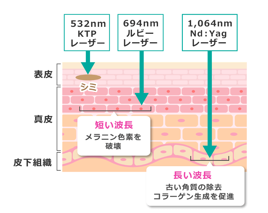 短い波長のレーザーはメラニン色素を破壊。長い波長のレーザーは古い角質の除去やコラーゲン生成を促進させる。